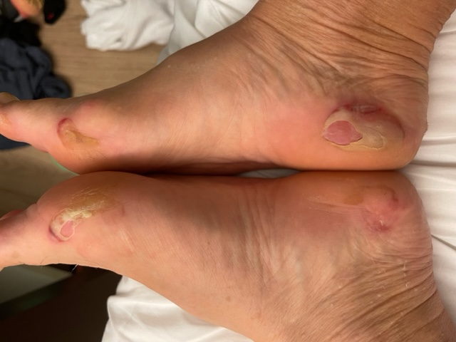 Feet with healing blisters