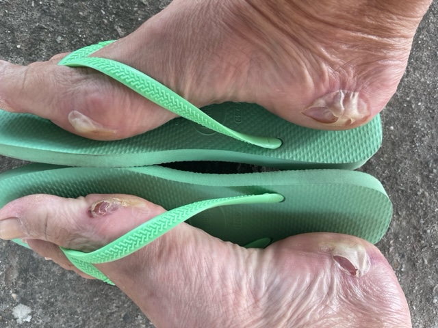 Feet with drying blisters